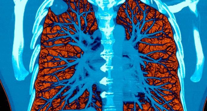 Kako prepoznati karcinom pluca